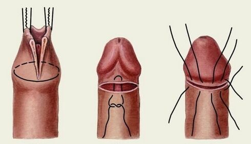 bistvo operacije povečanja penisa