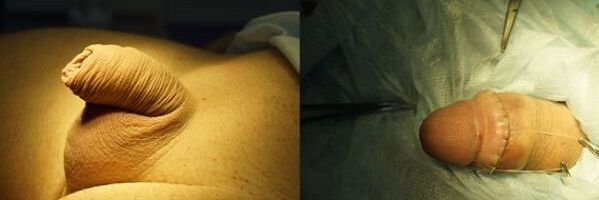 penis pred in po operaciji povečanja