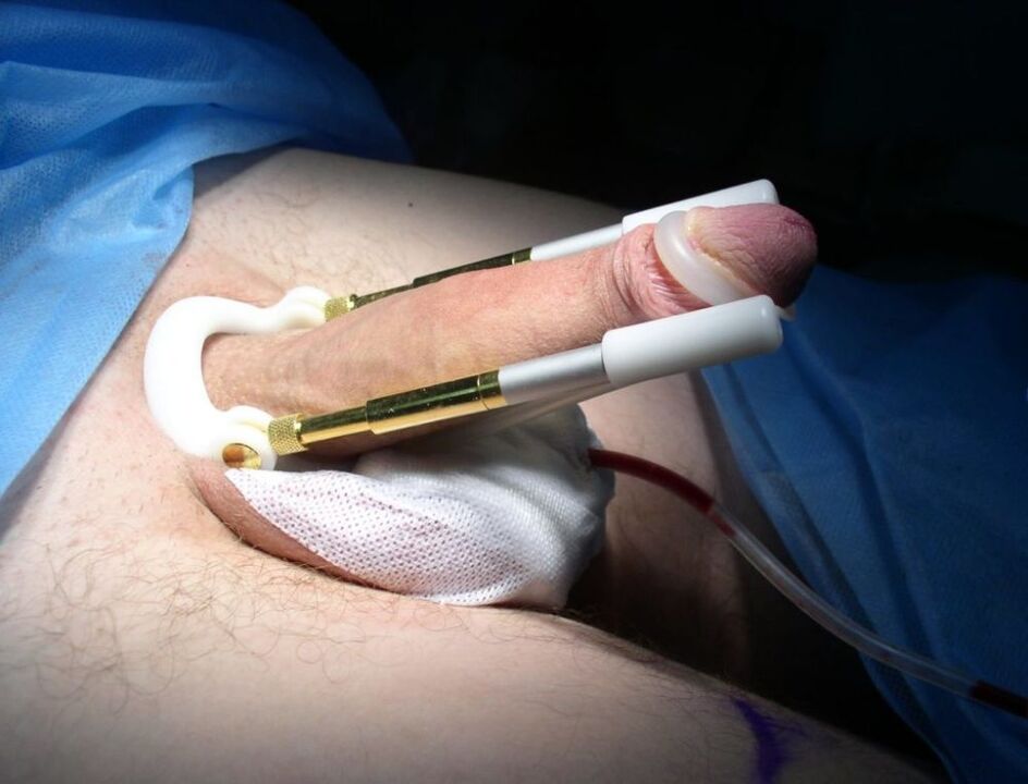 podaljšek po operaciji povečanja penisa