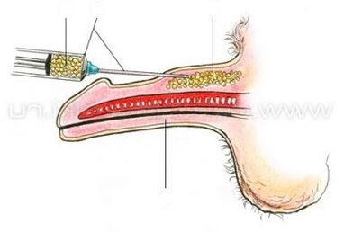 injekcijsko povečanje penisa